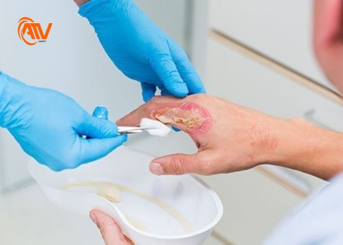 Các cách sơ cứu bỏng hóa chất