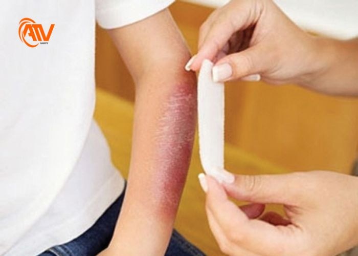 Sơ cứu bỏng do nhiệt/nắng đúng chuẩn