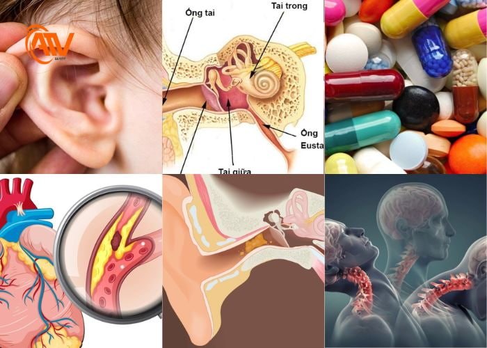 Những nguyên nhân gây ra bệnh ù tai