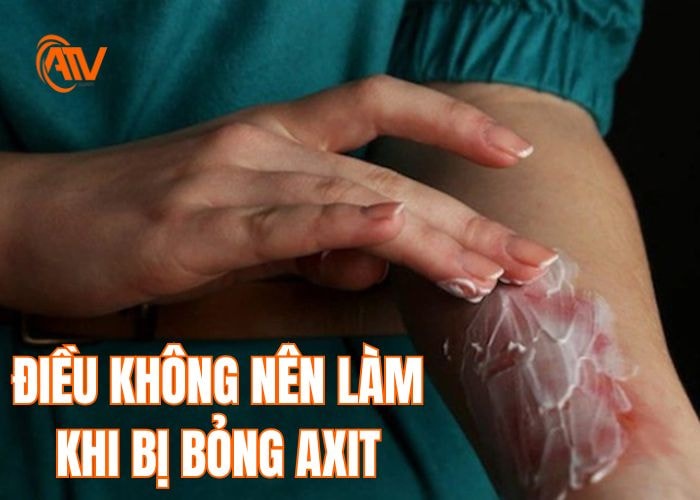 Những điều tuyệt đối không nên làm bị bỏng axit
