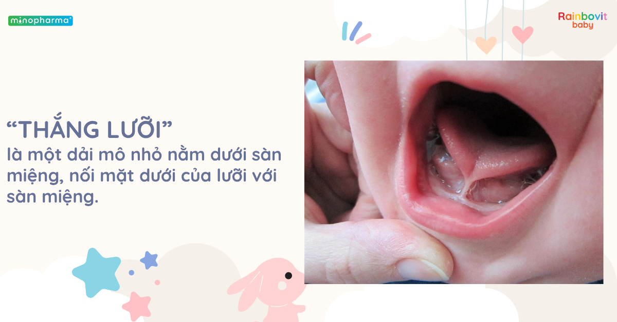 Dính thắng lưỡi ở trẻ (Ankyloglossia): Khi nào cần cắt?
