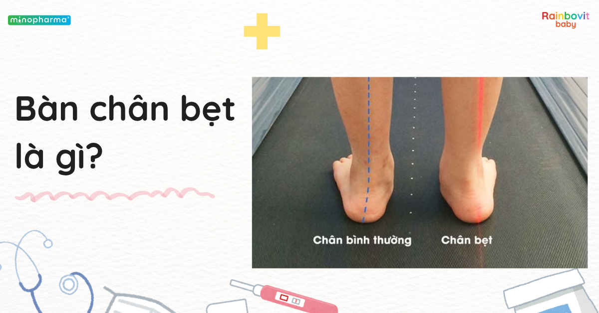 Hội chứng bàn chân bẹt ở trẻ: Bình thường hay bệnh lý?
