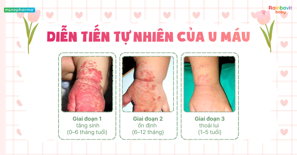 U máu ở trẻ nhỏ – Khi nào tự hết, khi nào cần điều trị?