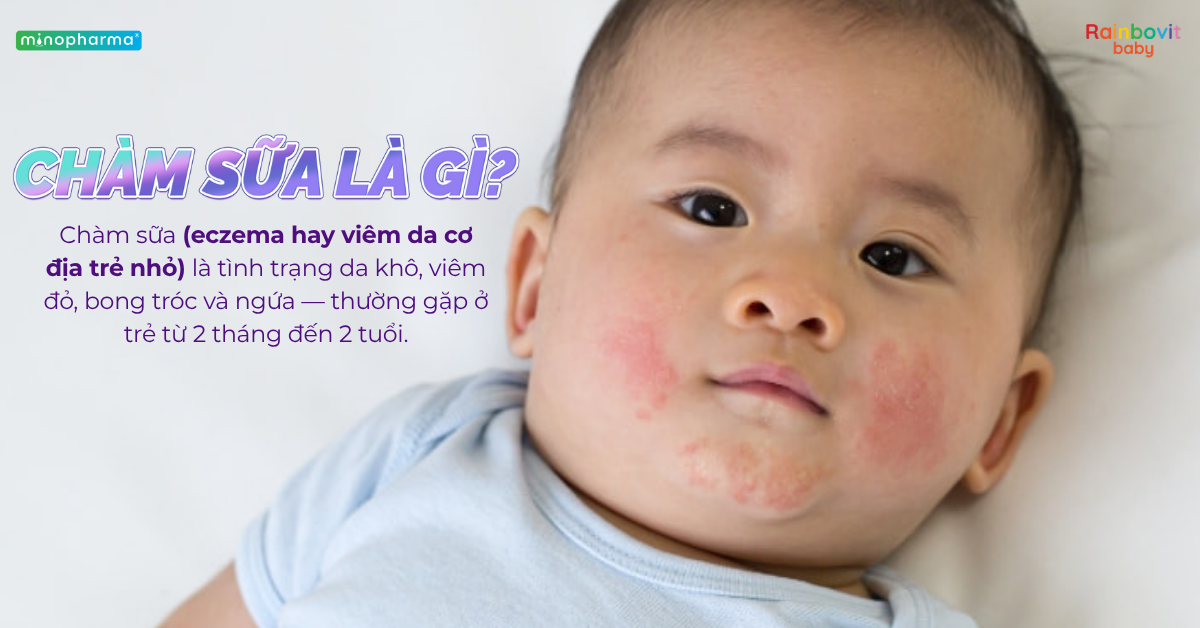 Chàm sữa ở trẻ nhỏ: Nguyên nhân, cách chăm sóc và phòng ngừa tái phát