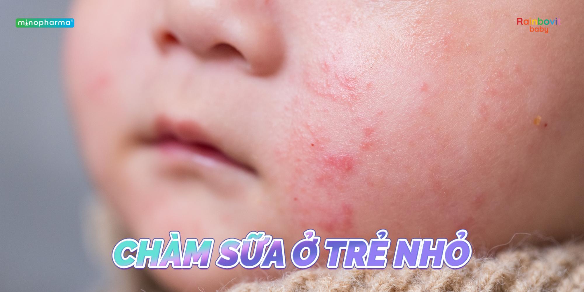 Chàm sữa ở trẻ nhỏ: Nguyên nhân, cách chăm sóc và phòng ngừa tái phát