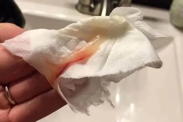 Bong nút nhầy tử cung