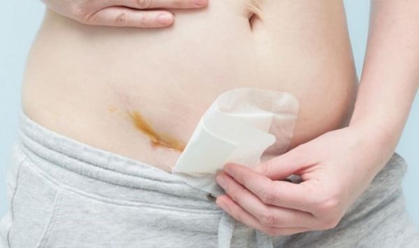 Cách vệ sinh vết mổ sau sinh tại nhà