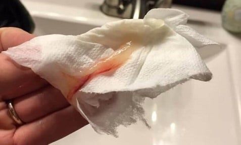 Dịch nhầy hồng sắp sinh