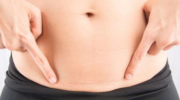 Mất ngủ sau sinh mổ