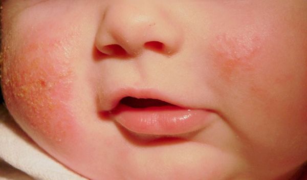 Mụn sữa và da bong tróc