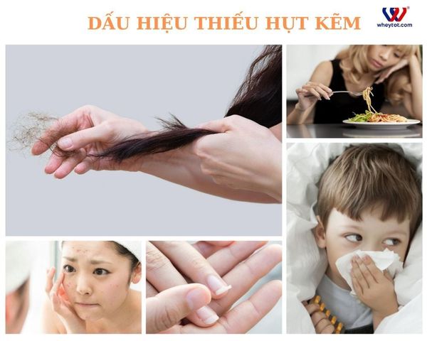 Dấu hiệu thiếu hụt kẽm của cơ thể
