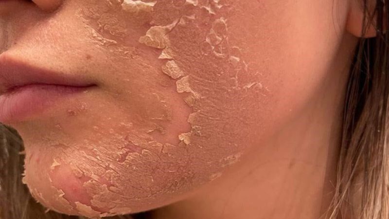 Ai nên dùng viên uống chống nắng?