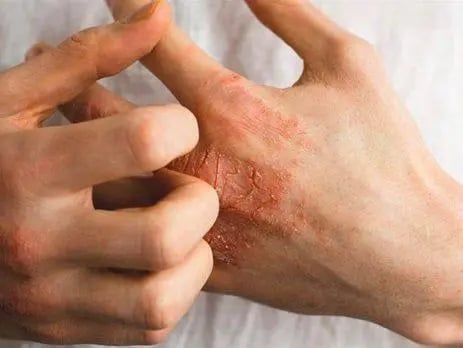 Chàm Thần Kinh (Neurodermatitis)