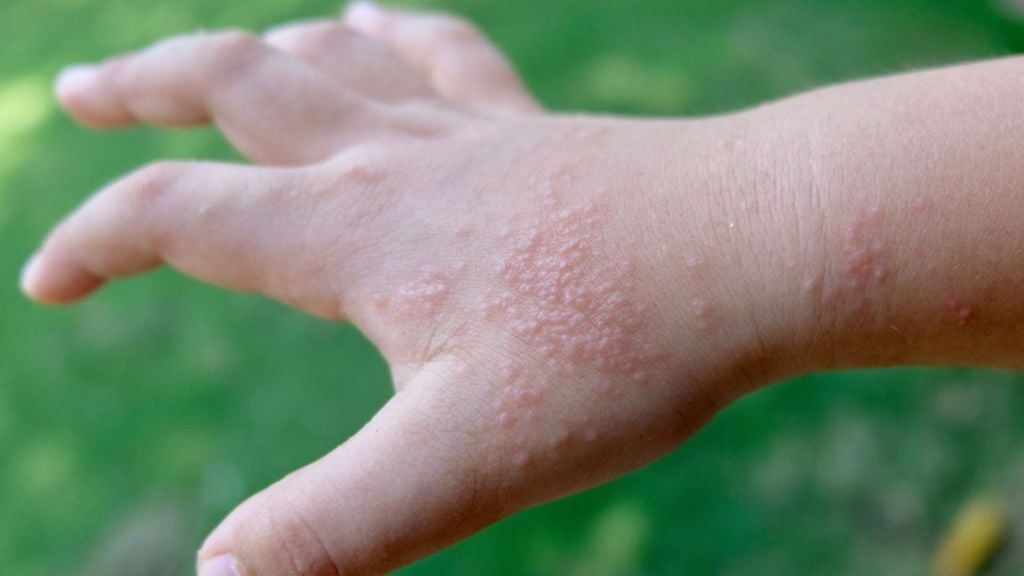 Chàm Tổ Đỉa (Dyshidrotic Eczema)