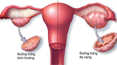 Hội chứng buồng trứng đa nang (PCOS)
