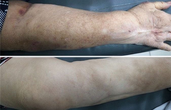 Cảnh báo: 4 phương pháp trị tổ đỉa nếu lạm dụng lâu ngày có thể gây hại cho toàn thân