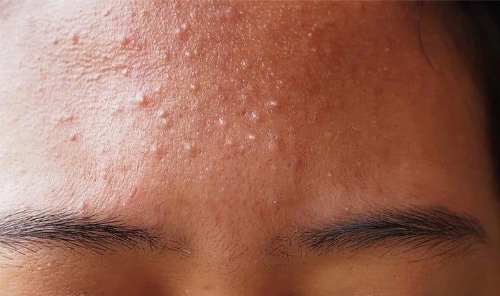 Da Càng Treatment Càng Đỏ: Nguyên Nhân Là Gì