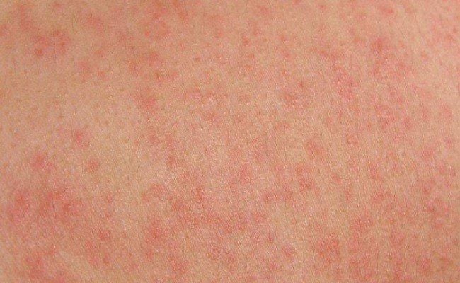 5 DẤU HIỆU CẢNH BÁO BẠN ĐANG NUÔI “THÚ CƯNG” TRONG RUỘT