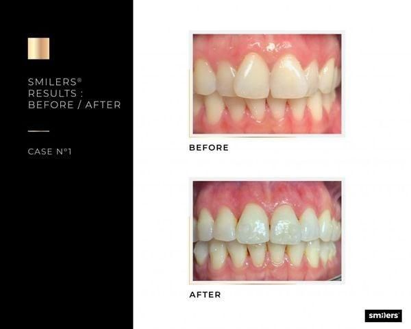 Clear aligner SMILERS®