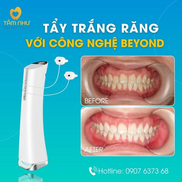 Tẩy trắng răng tại Nha khoa Tâm Như