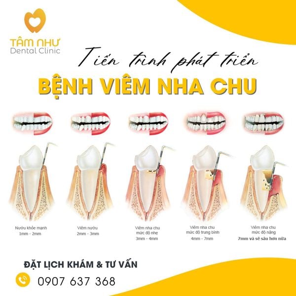 Cấp độ phát triển của bệnh Viêm nha chu