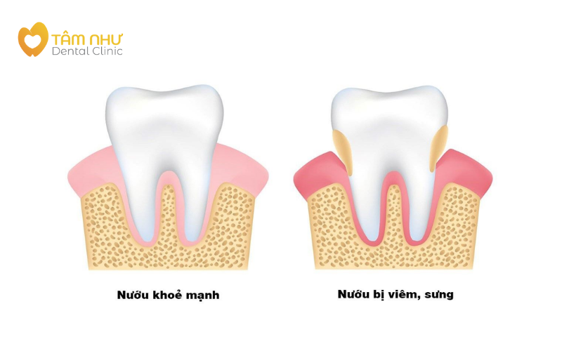 Viêm nha chu là gì?