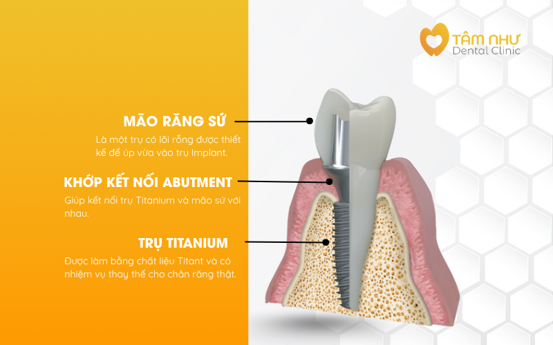 Cấu tạo trụ Implant