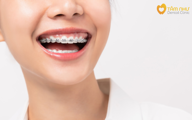 Lợi ích khi niềng răng