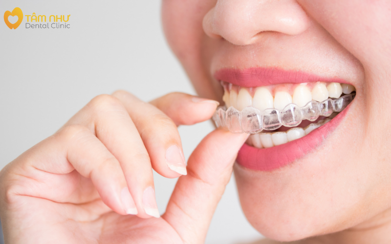 Niềng răng trong suốt