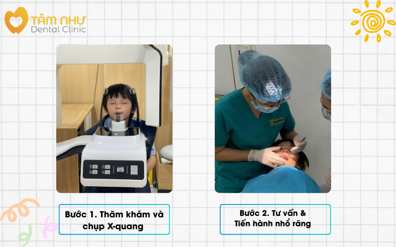 Quy trình Nhổ răng sữa tại Nha khoa Tâm Như