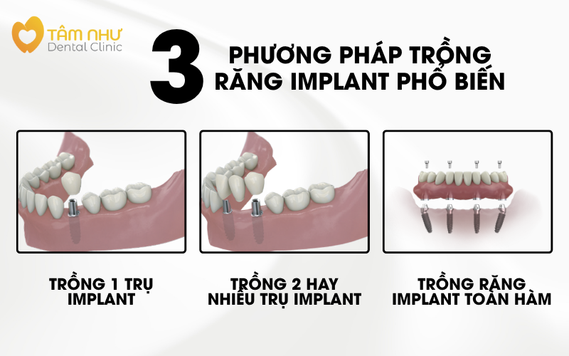 Các phương pháp trồng răng Implant