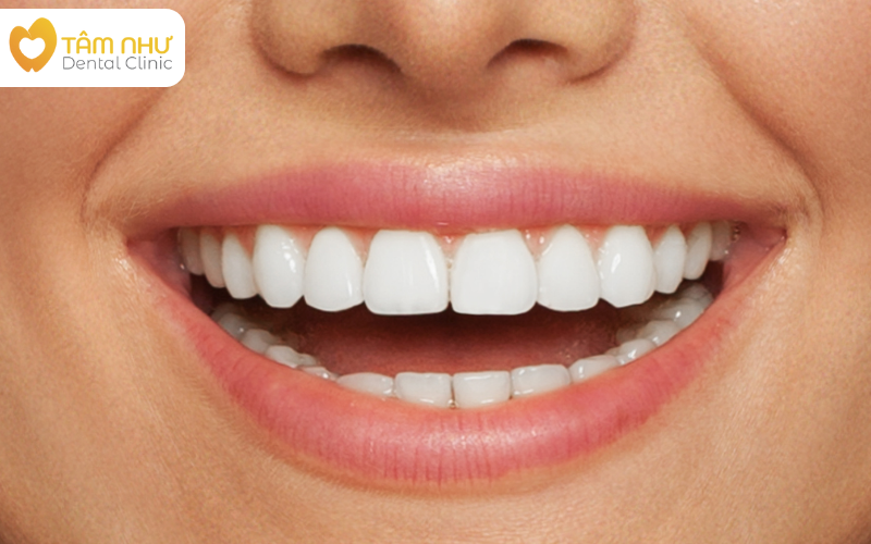 Răng sứ thẩm mỹ