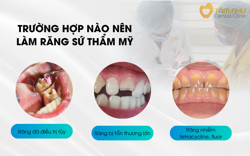 Trường hợp nào nên bọc răng sứ