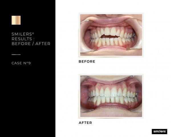 Clear aligner SMILERS®