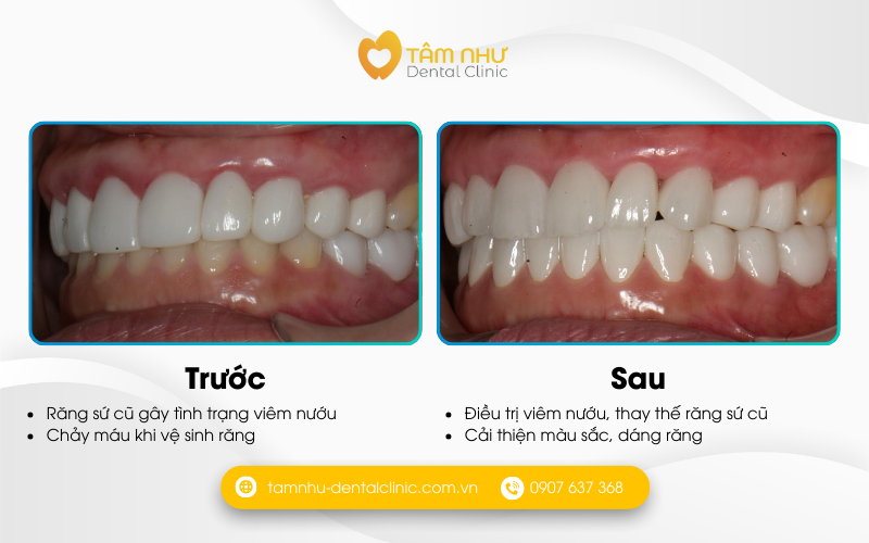 Răng sứ thẩm mỹ tại Nha khoa Tâm Như