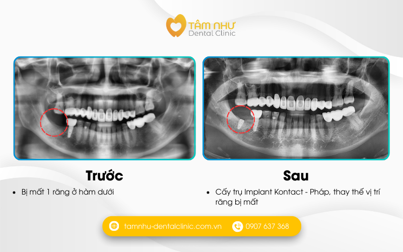Trồng răng Implant