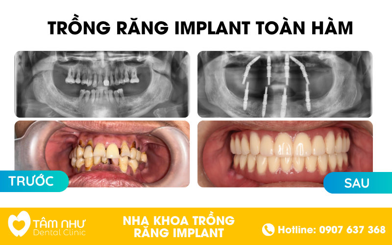 Trồng răng Implant toàn hàm