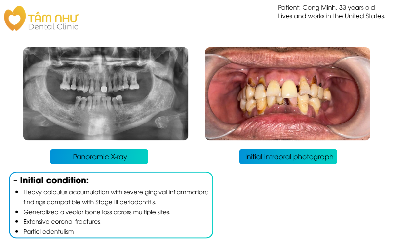 Dental Implant