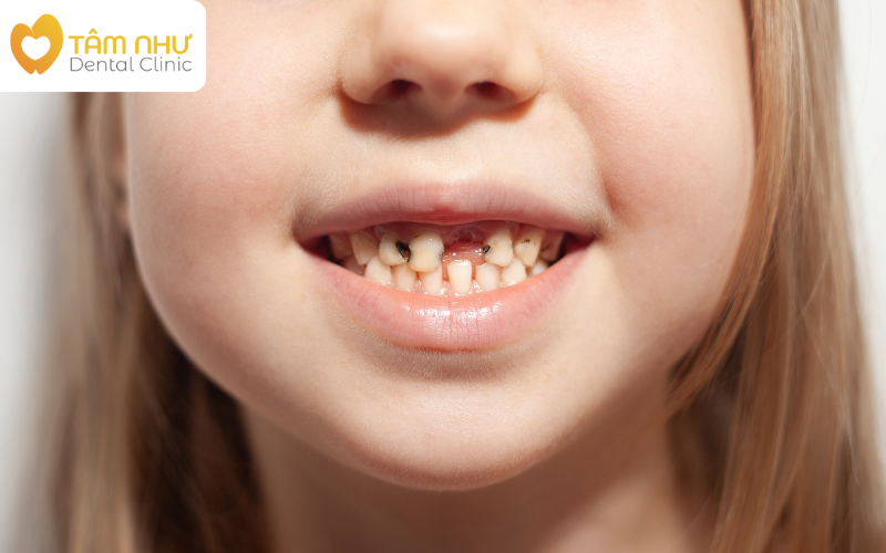 Nhổ răng sữa là gì?