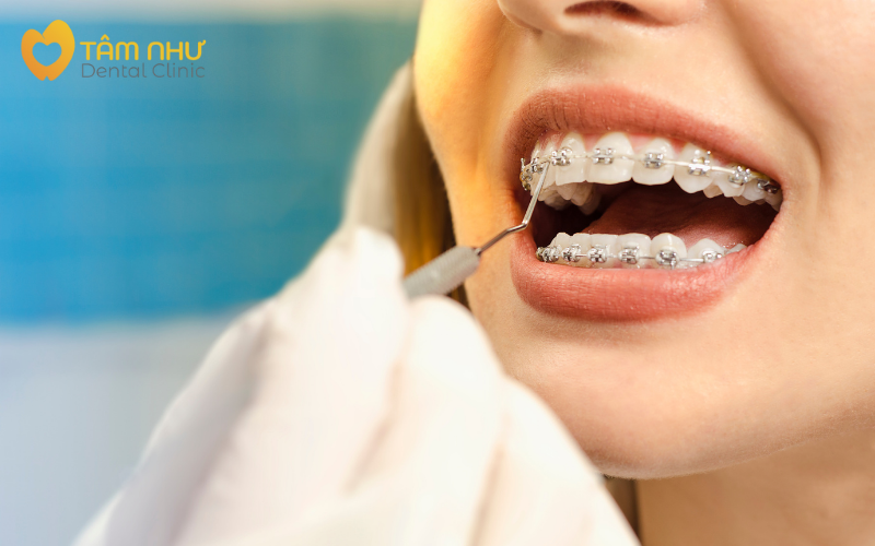 Niềng răng mắc cài