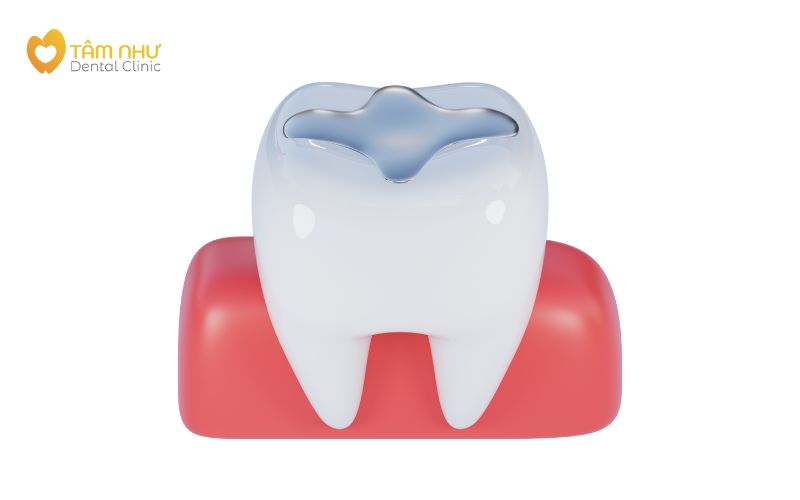 Trám răng là gì?