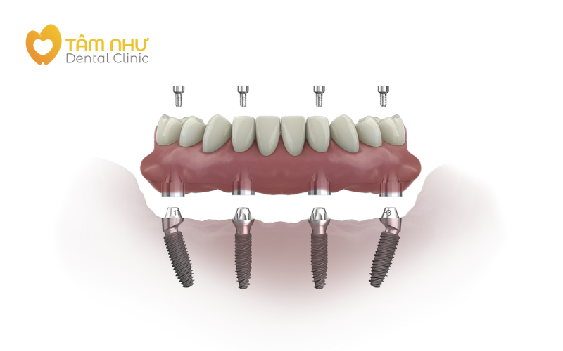 Dental Implant