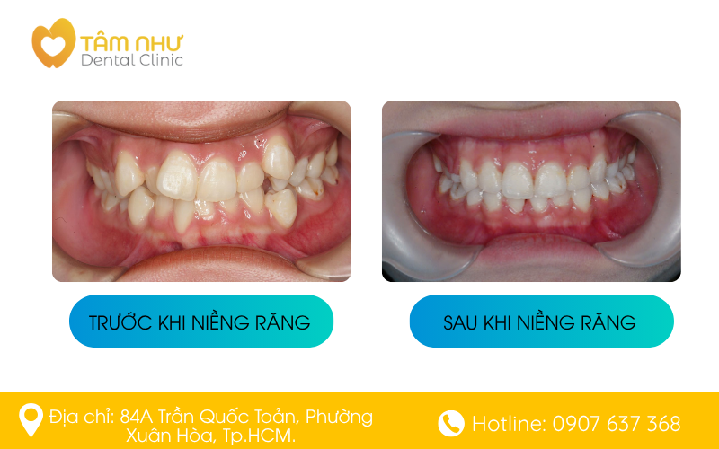 Kết quả trước - sau khi niềng răng