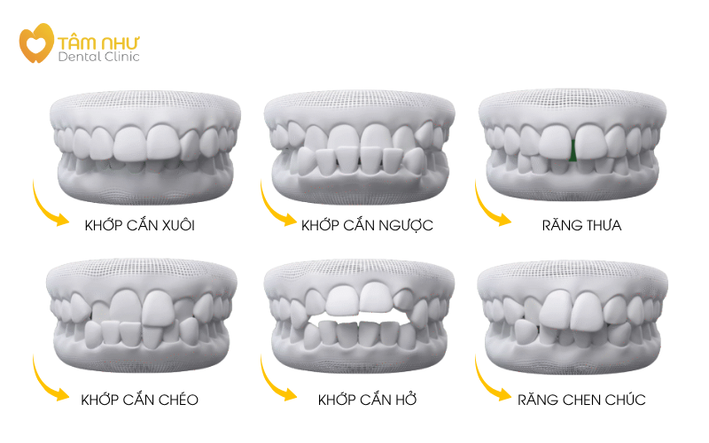 Trường hợp nào cần niềng răng