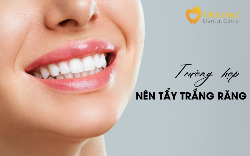 Trường hợp nào nên tẩy trắng răng