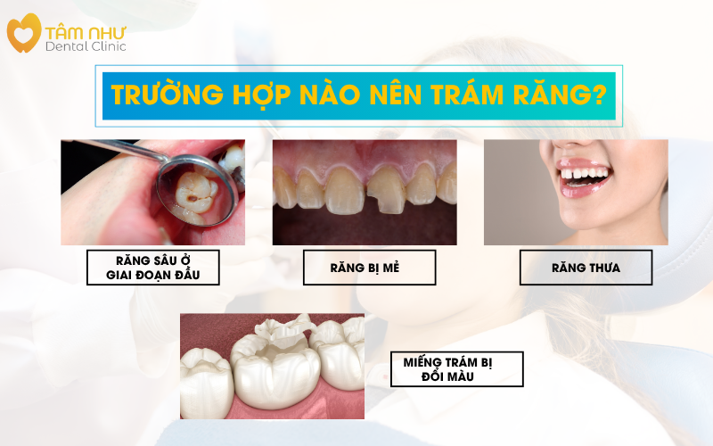 Trường hợp nào nên trám răng