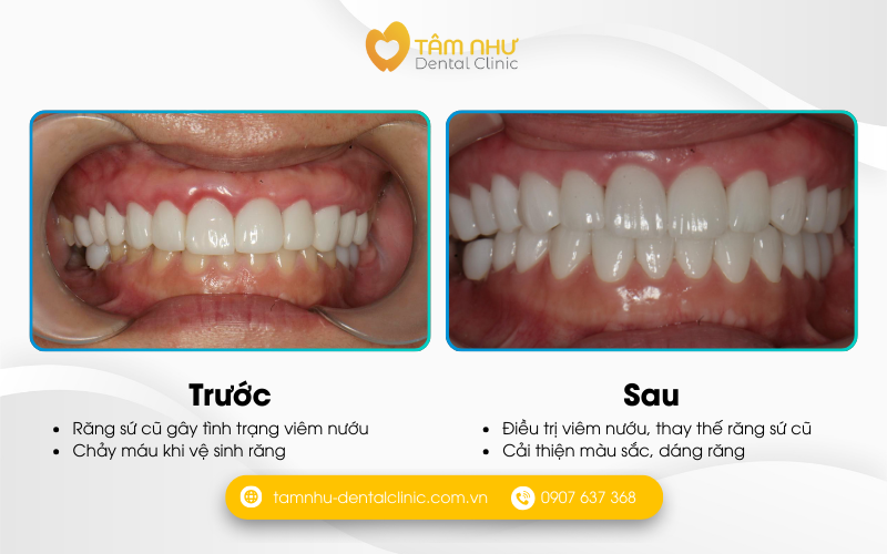 Răng sứ thẩm mỹ