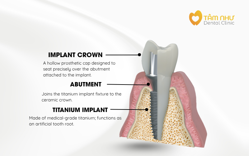 Dental Implant
