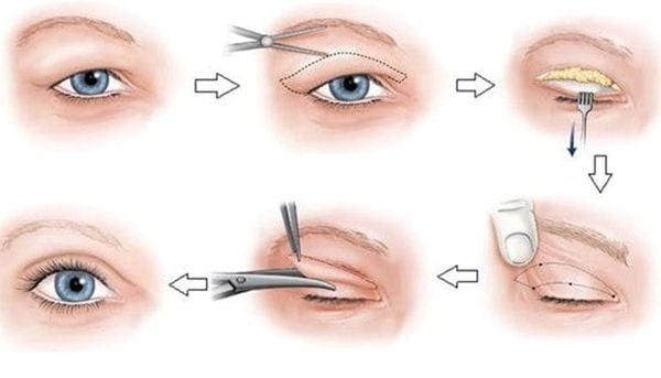 CẮT MÍ CHUẨN HÀN