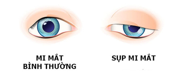 ĐIỀU TRI SỤP MI BẨM SINH